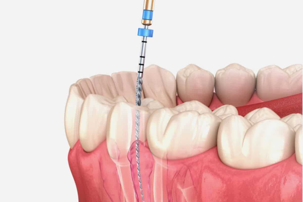 root canal therapy Hewlett