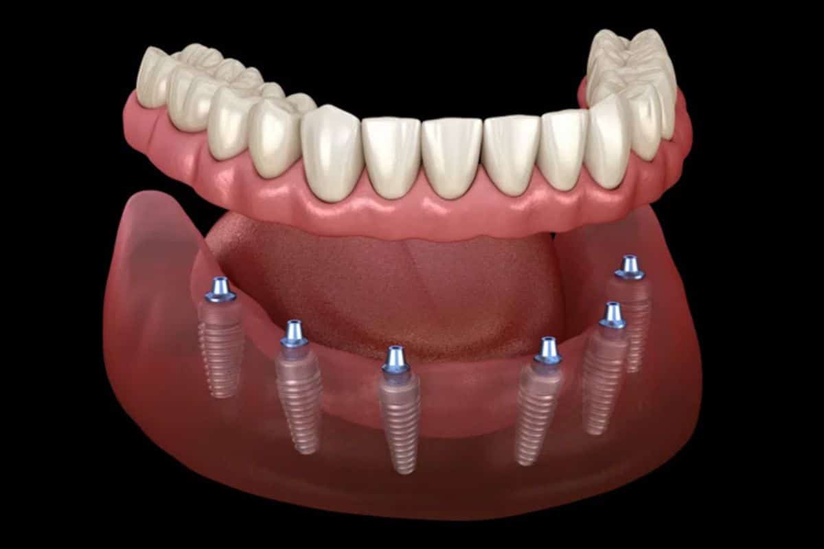 full arch implants in Hewlett