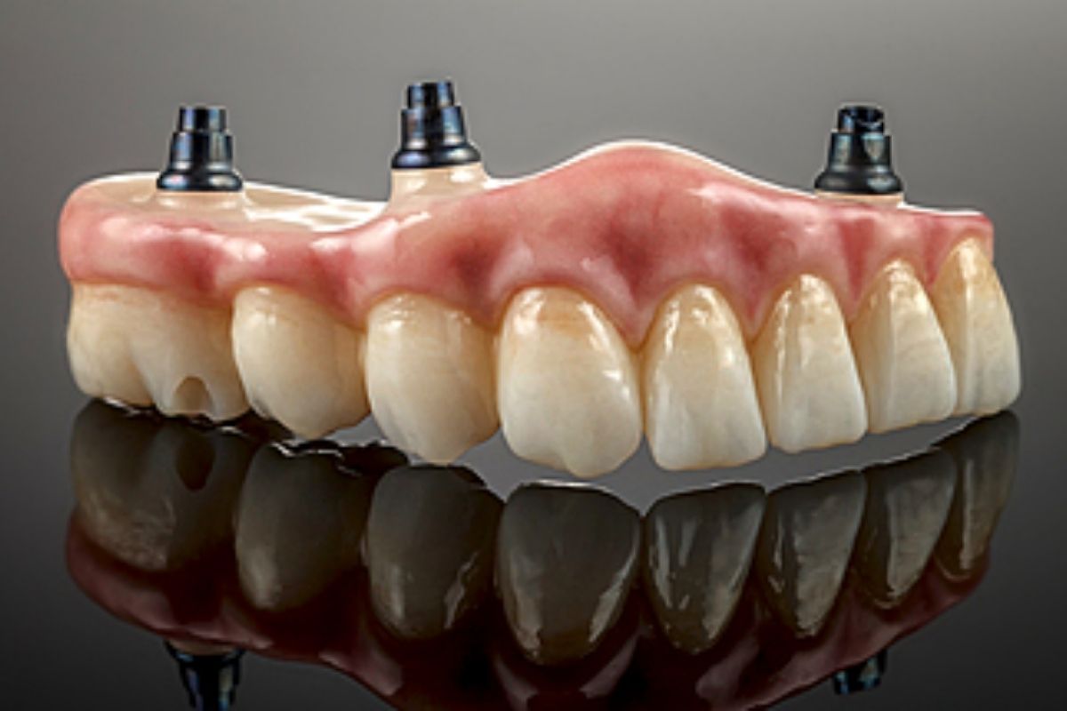 All on 4 Implants in Hewlett, NY