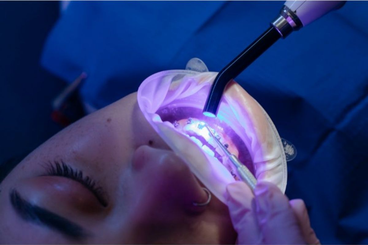 Teeth whitening is being performed at Smiles By Design in Hewlett, NY