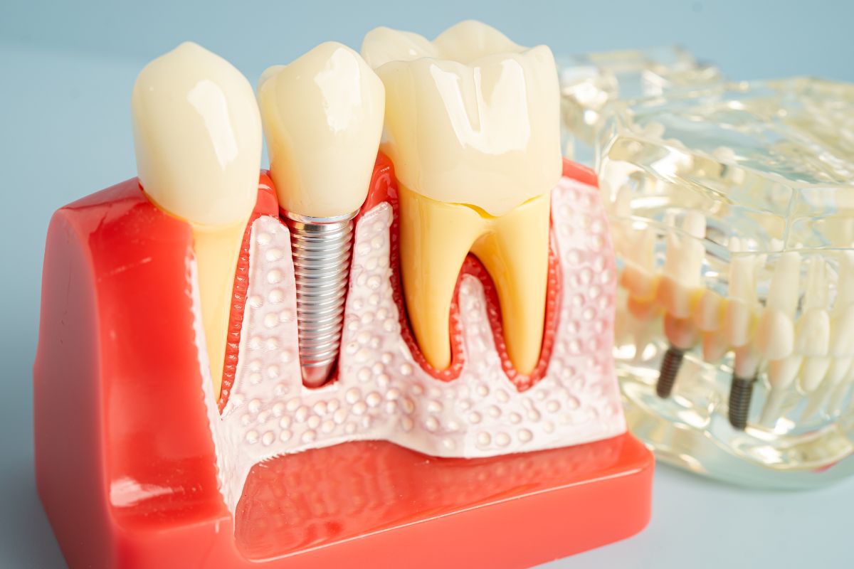 dental-implants-hewlett-ny