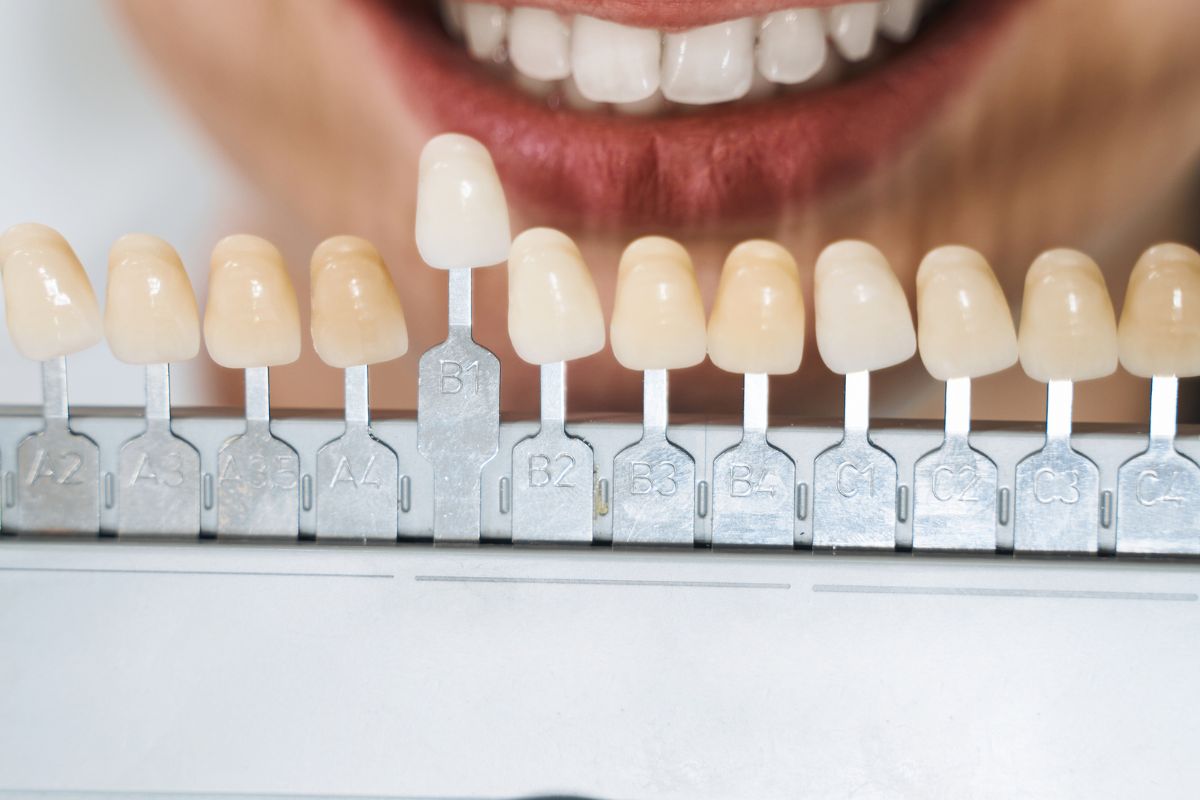 veneers-cosmetic-dentist-hewlett-ny