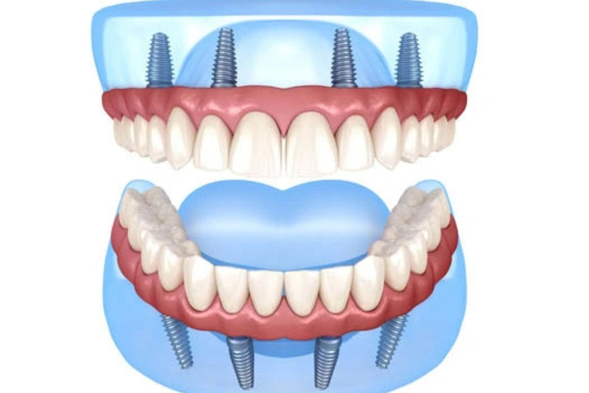 all-on-4-implants-prosthodntist-hewlett-ny