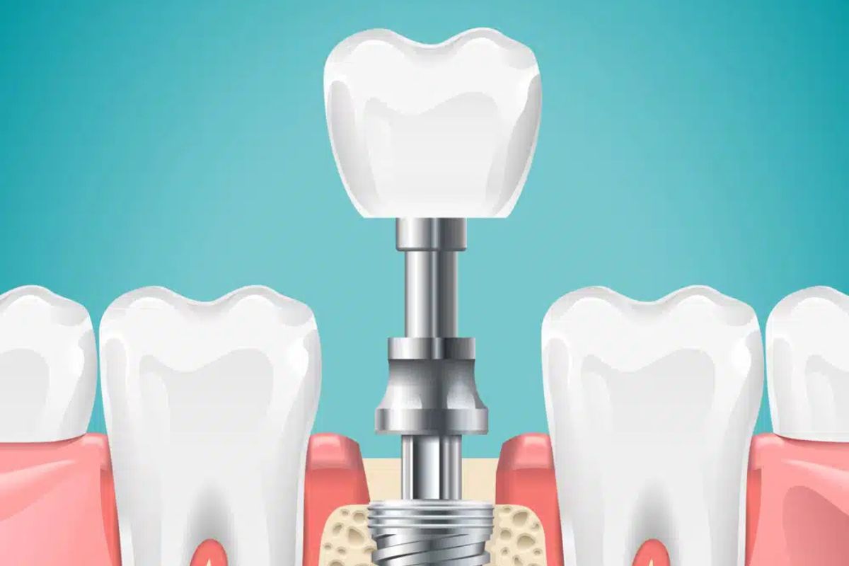 dental-implants-hewlett-ny
