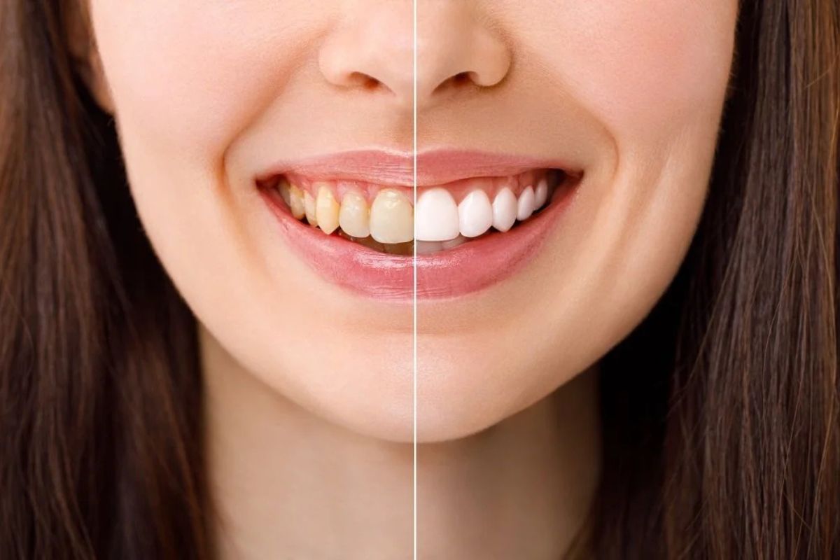 teeth-whitening-cosmetic-dentist-hewlett-ny