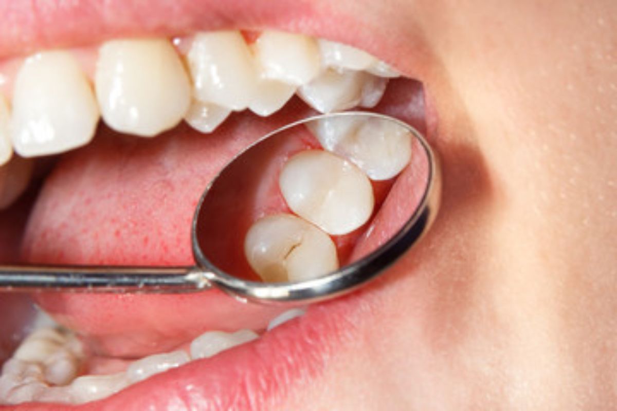 can-same-day-crowns-be-placed-on-back-molars